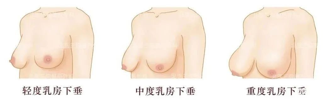 乳房下垂都是因为不穿内衣导致的? 图片-5