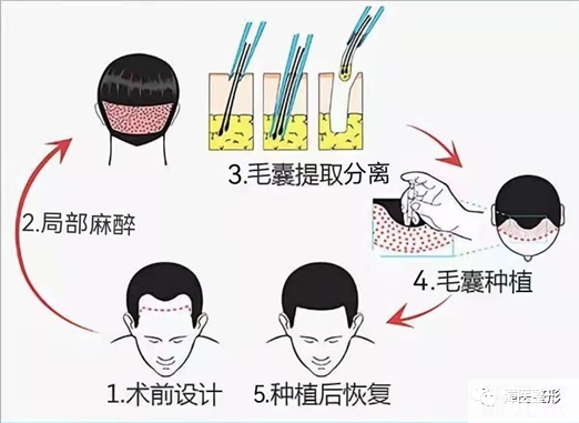植发,终于不“秃”然了 图片-9