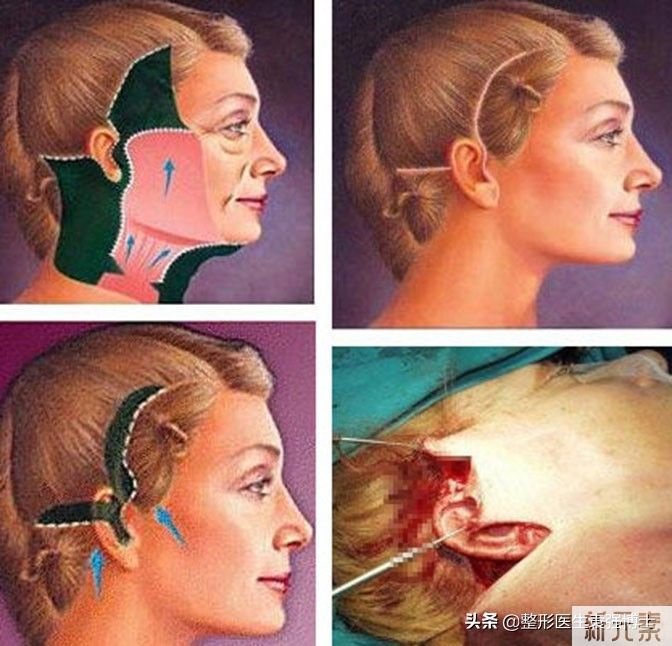 拉皮手术副作用(后遗症),医生总结这篇文章告诉你 图片-1