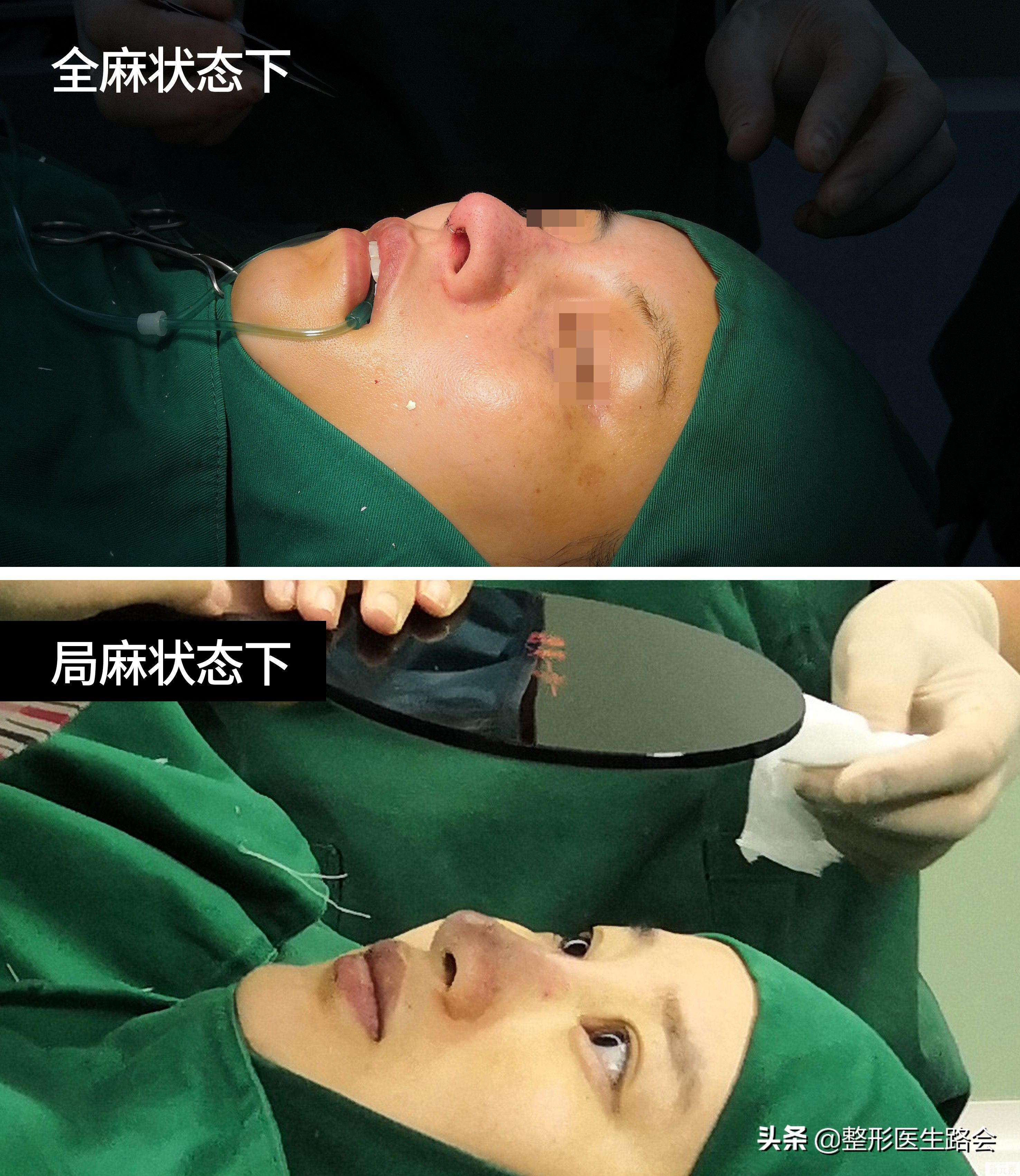 隆鼻手术到底是全麻好?还是局麻好? 图片-1