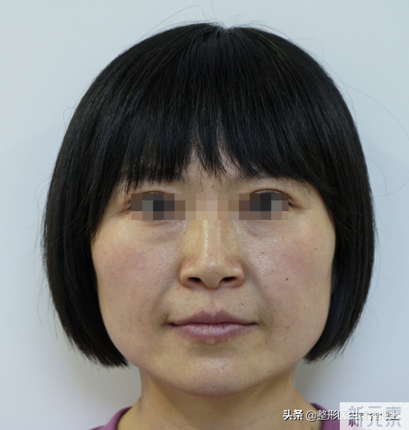 38岁接受不了松垂脸,上北京小拉皮全程真实记录,变化大 图片-1