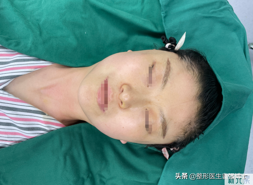 38岁接受不了松垂脸,上北京小拉皮全程真实记录,变化大 图片-4