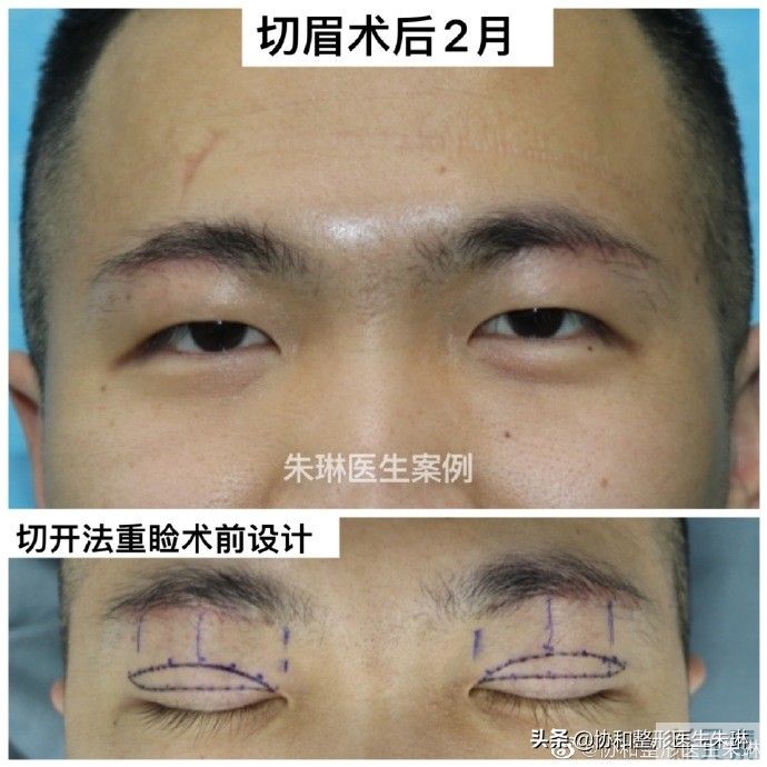 眼整形功课系列:厚重的肿眼泡眼睛应该如何 图片-4