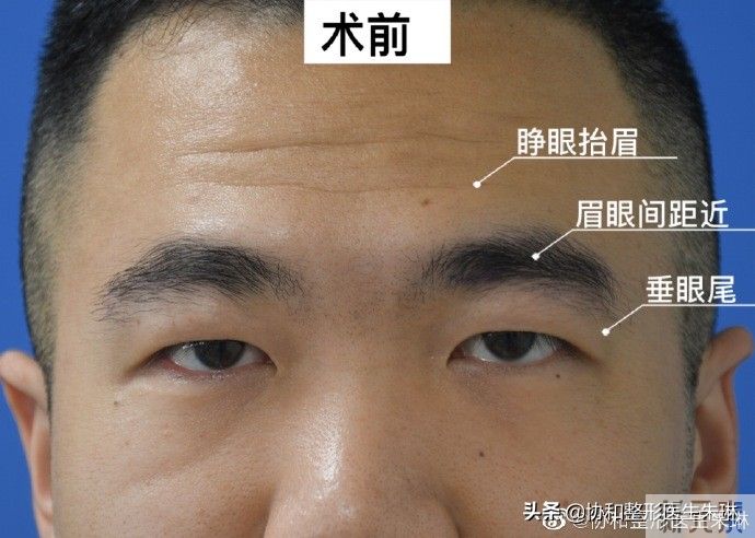 眼整形功课系列:厚重的肿眼泡眼睛应该如何 图片-1