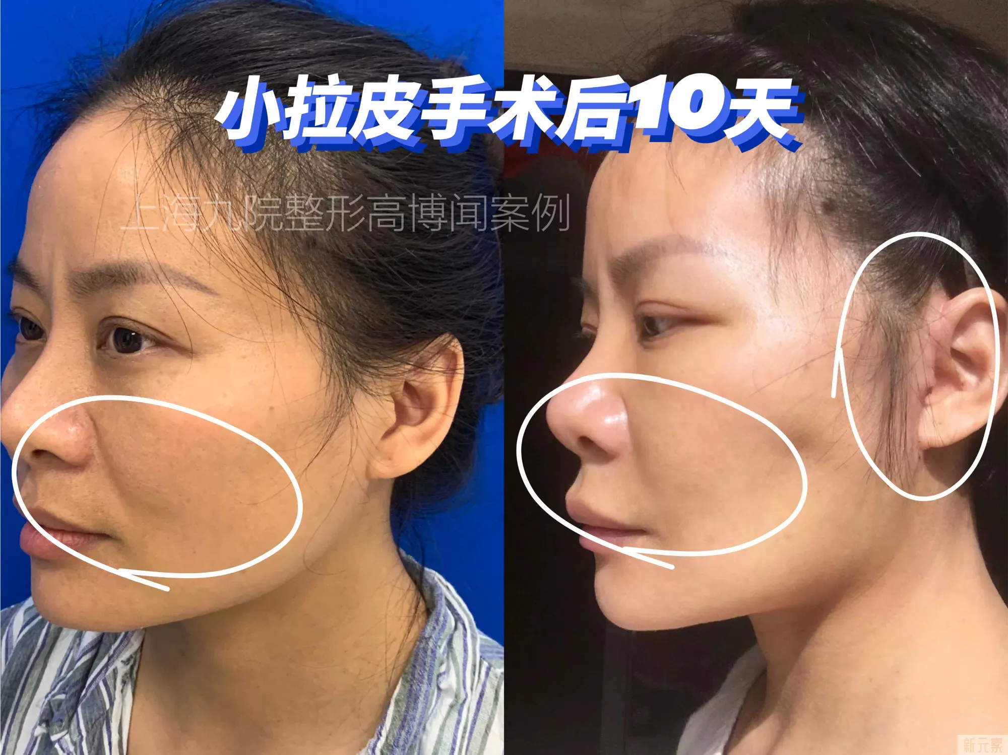 小拉皮切口是不是越小越好? 图片-1