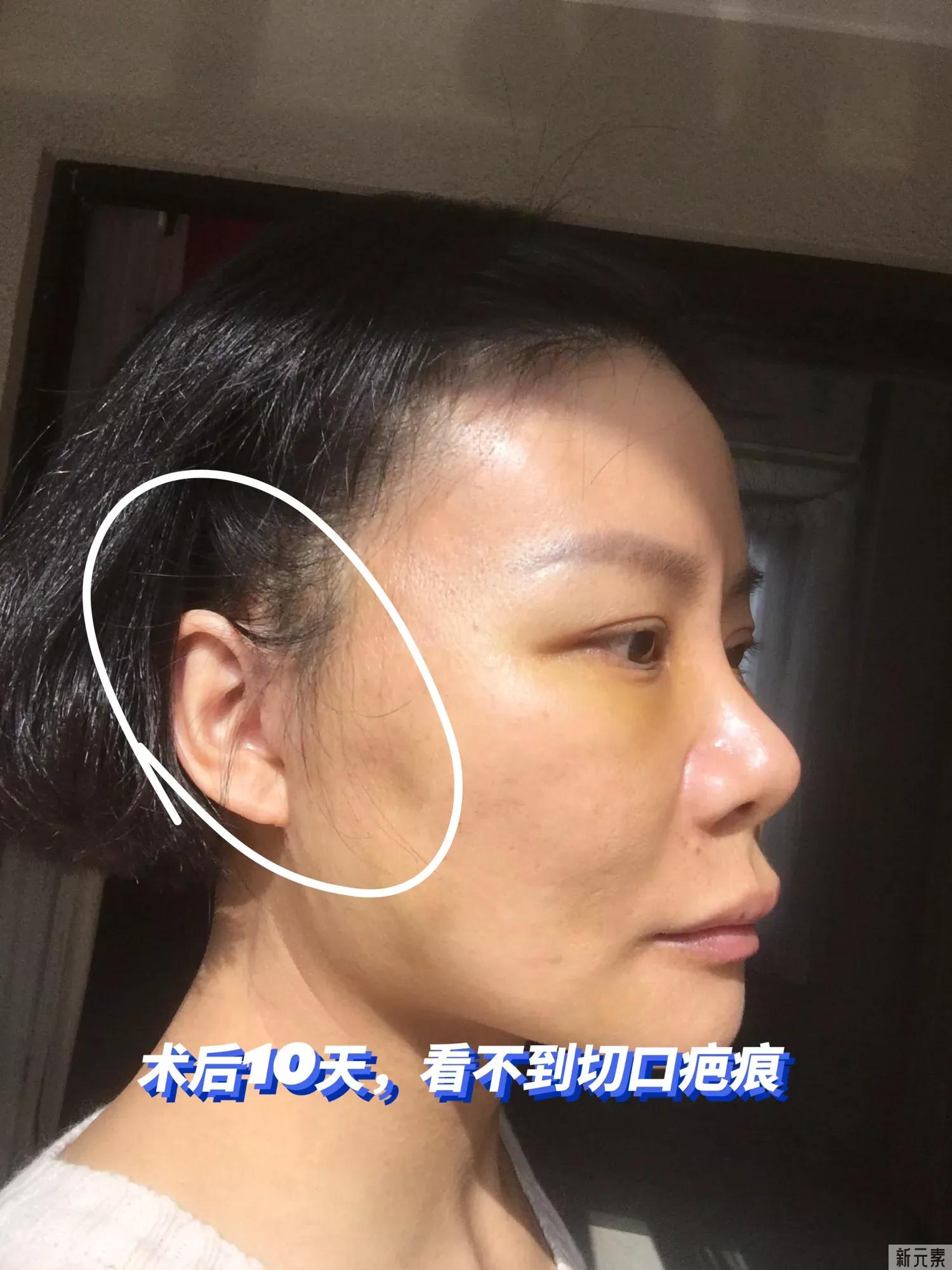 小拉皮切口是不是越小越好? 图片-3