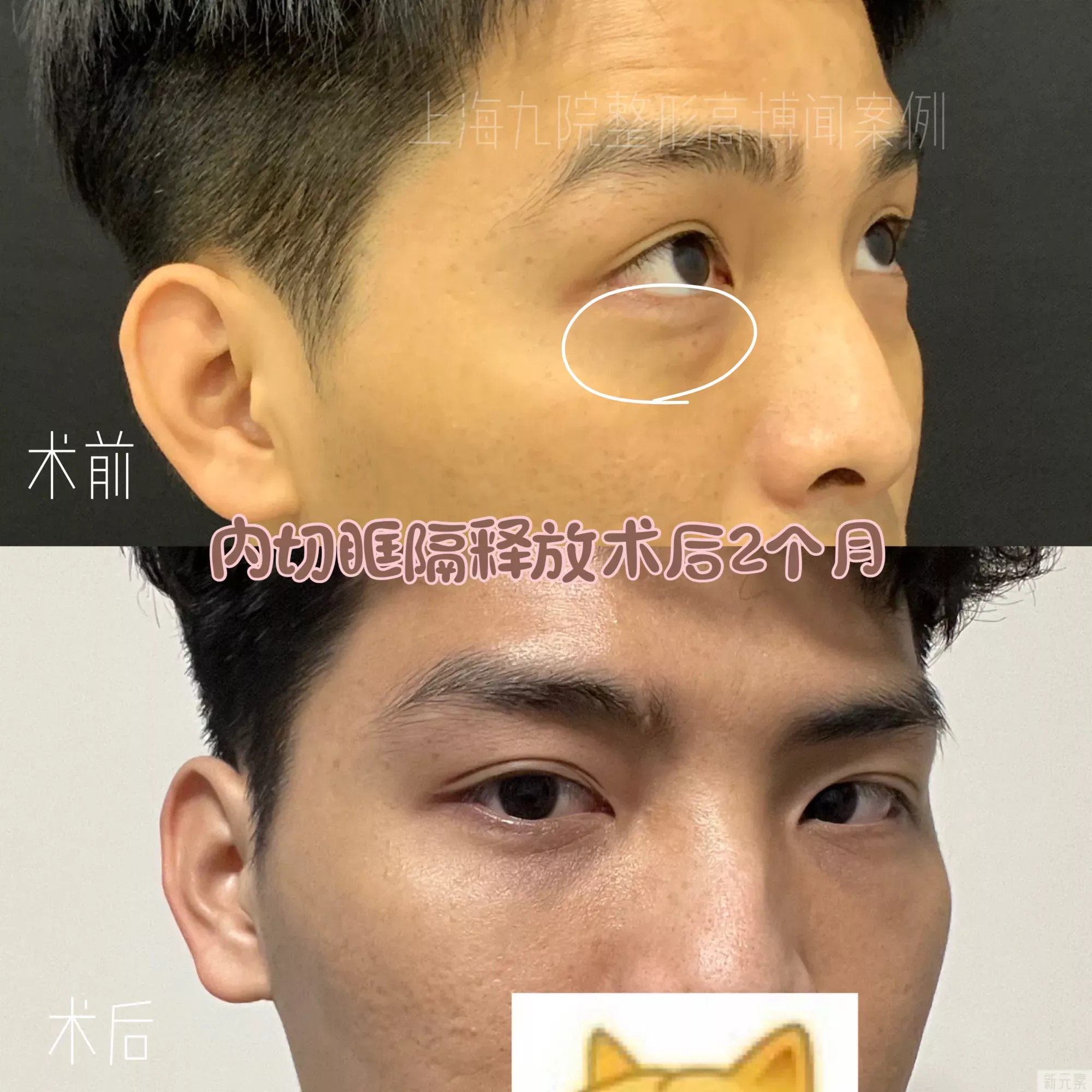 ❓做了内切眼袋手术第几天最肿啊?啥时候可 图片-1