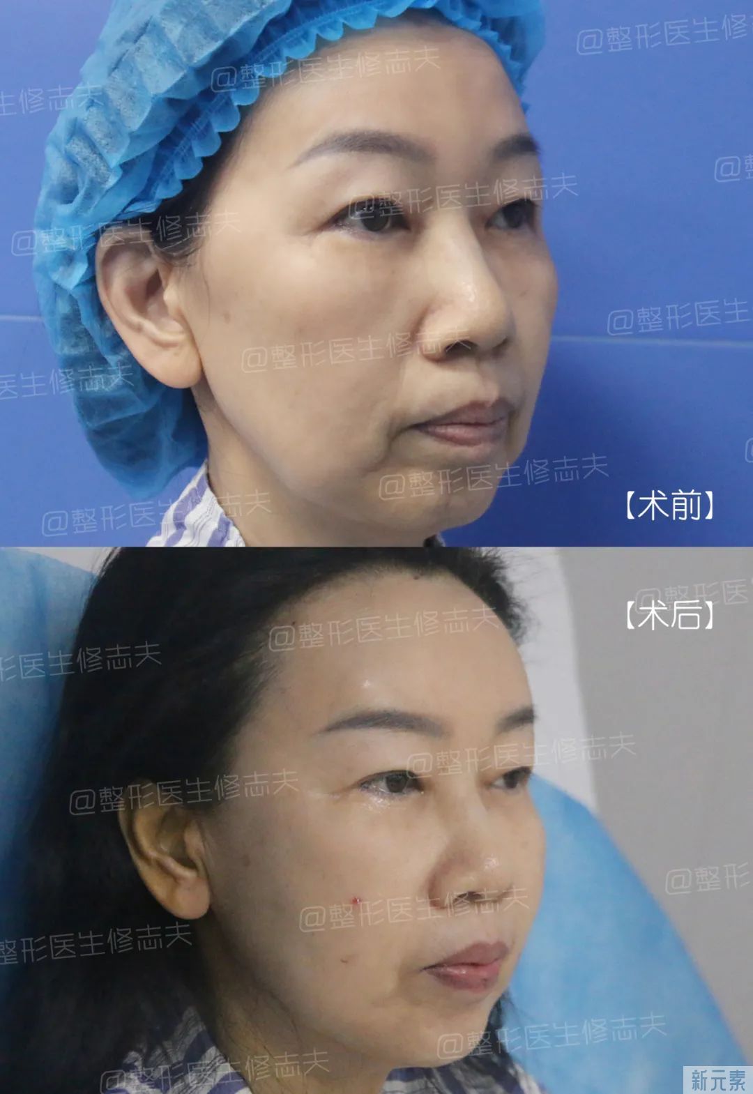 想不到吧,面部脂肪填充还有这个妙用 图片-9