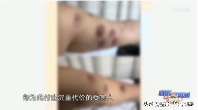 美甲美睫店里注射全身瘦溶脂针,导致客户皮 图片-14