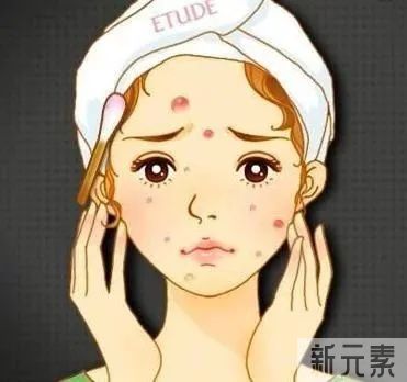 痘痘肌看过来,为什么你会长痘? 图片-6