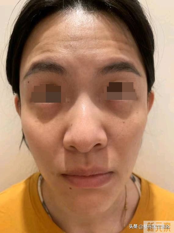 化妆都盖不住的“黑眼圈”,要怎么改善? 图片-1