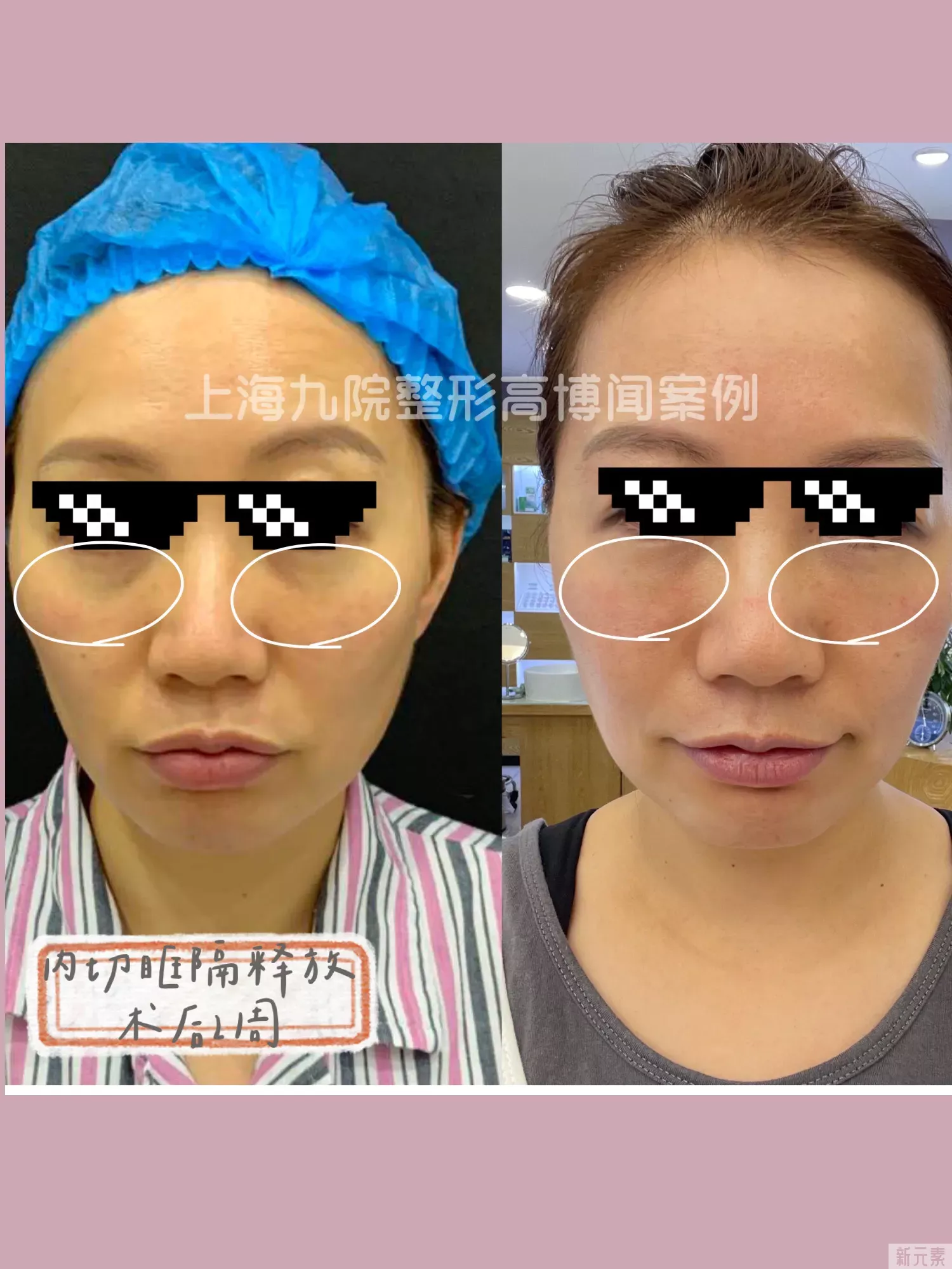 眼袋手术后多久可以打肉毒素? 图片-3