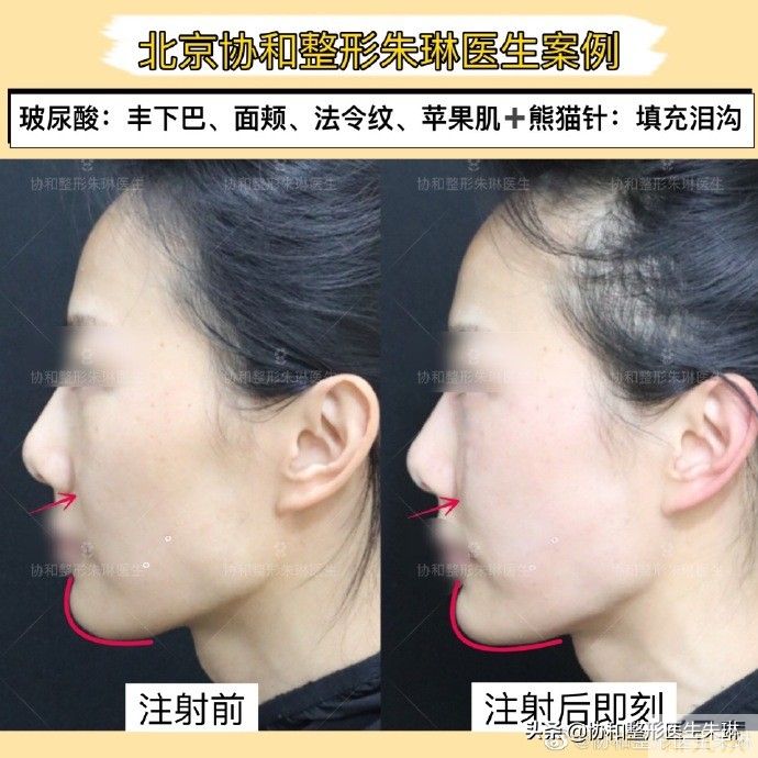 玻尿酸丰下巴、填充面颊、法令纹、苹果肌; 图片-2