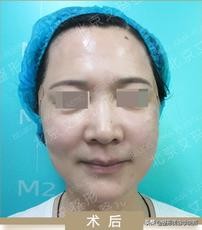 拉皮手术效果大曝光!口角赘肉和法令纹怎么 图片-2