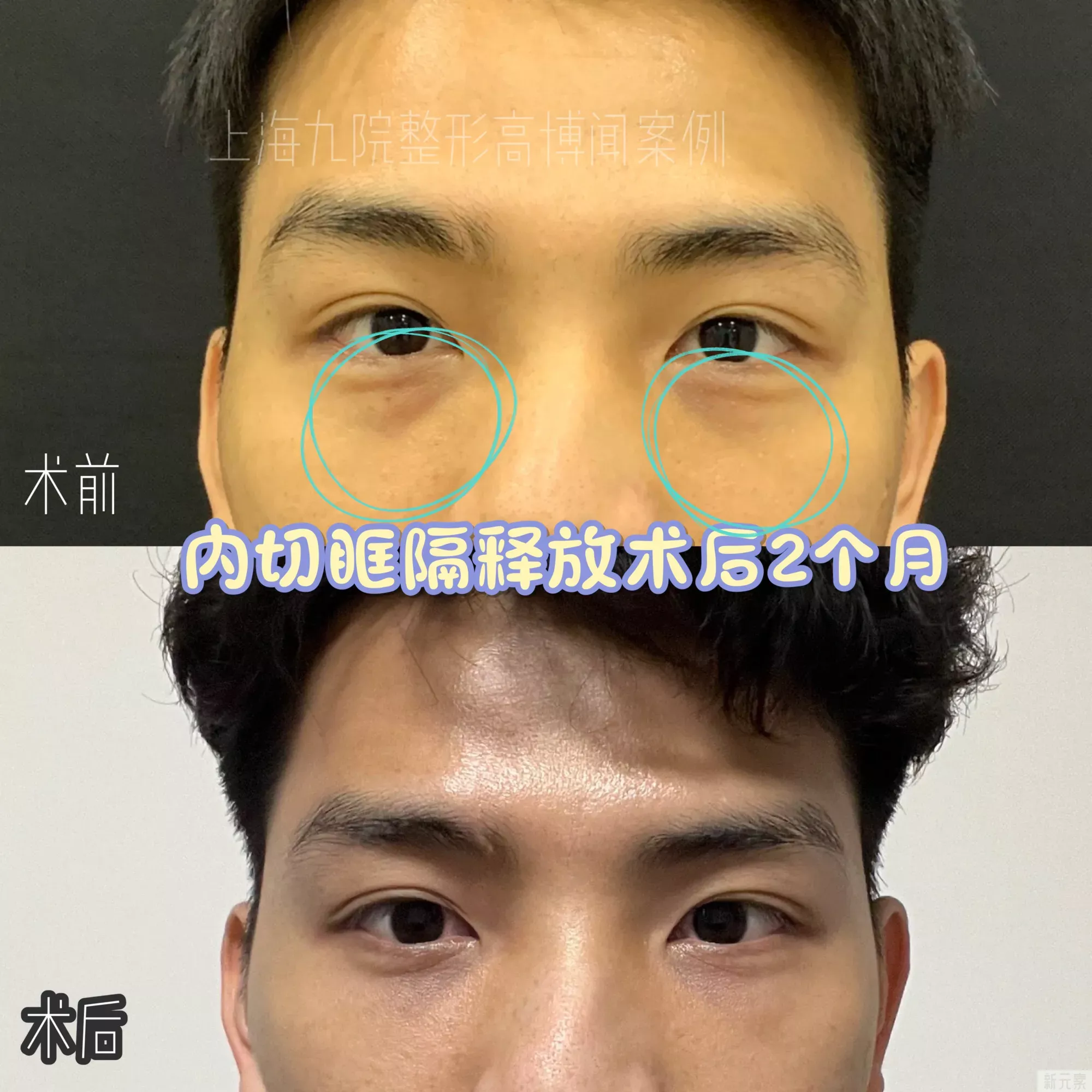 ❓割眼袋老了以后会怎么样?会有后遗症吗? 图片-2