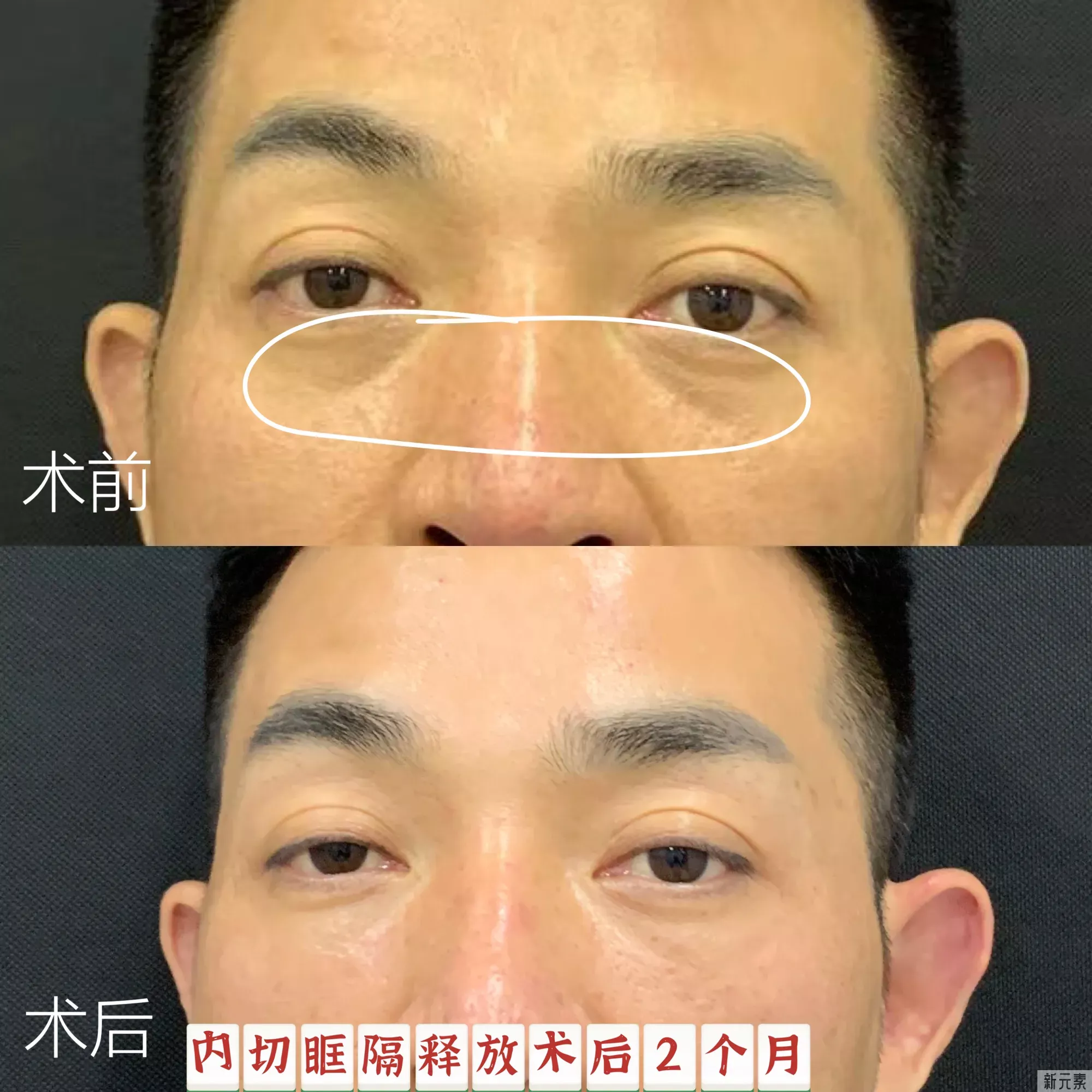 ❓割眼袋老了以后会怎么样?会有后遗症吗? 图片-3