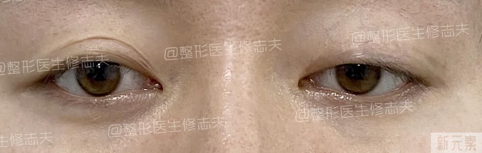 眼睑下垂是不是肌无力症状? 图片-2