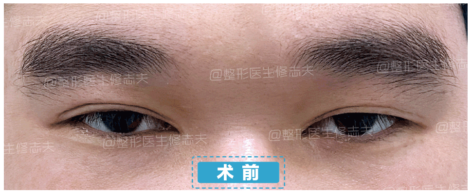 眼睑下垂是不是肌无力症状? 图片-3
