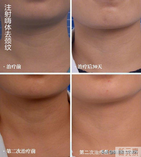 【颈纹真的很难看,羡慕别人的脖子?】 图片-1