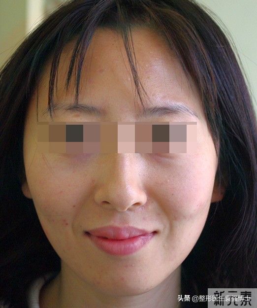 35岁上北京做了小拉皮,刚6天效果很“惊艳” 图片-1