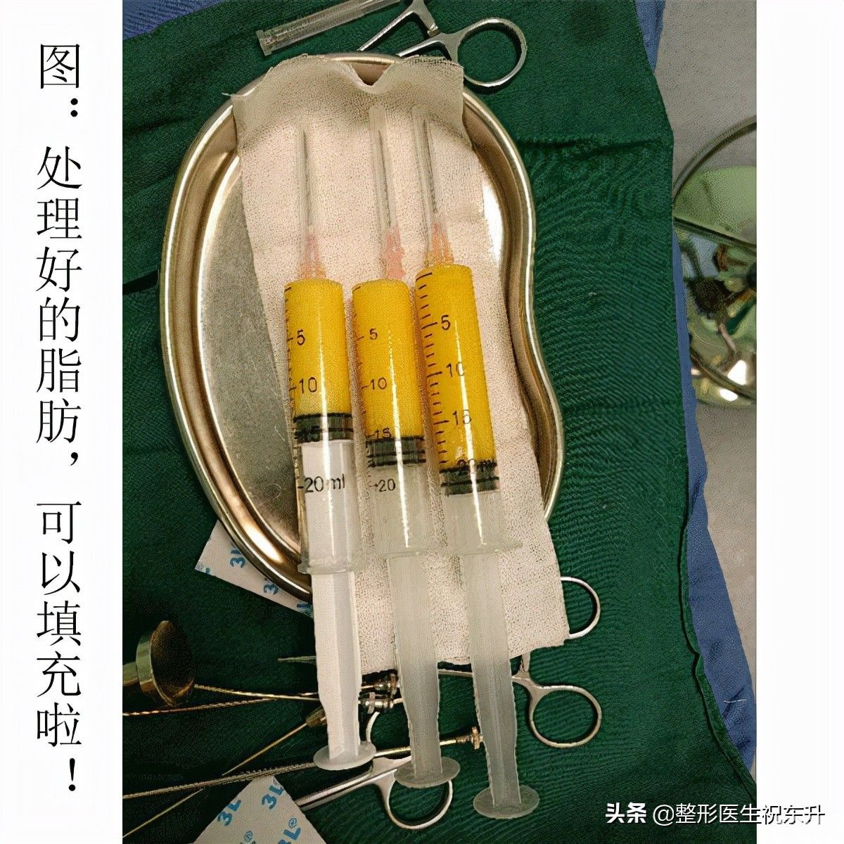 那些劝人别做“自体脂肪填充面部”的人,在说什么? 图片-3
