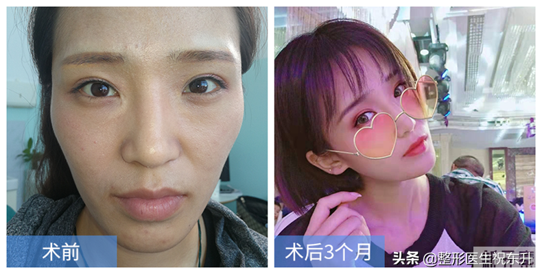 那些劝人别做“自体脂肪填充面部”的人,在说什么? 图片-2