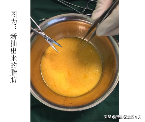 那些劝人别做“自体脂肪填充面部”的人,在说什么? 图片-1