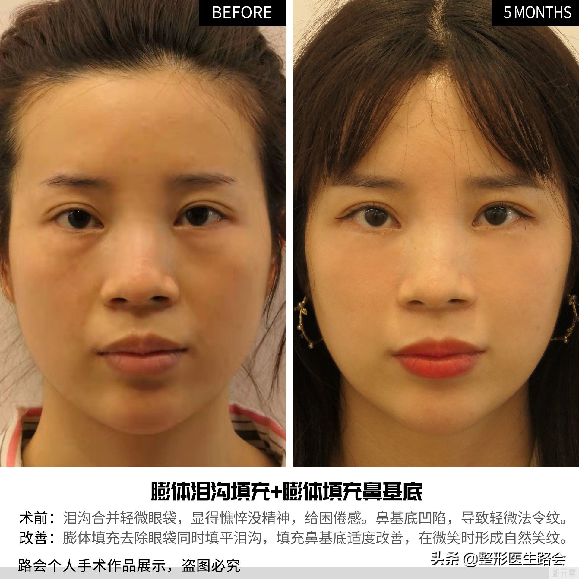 想垫鼻基底,过来人交代你几件事! 图片-1