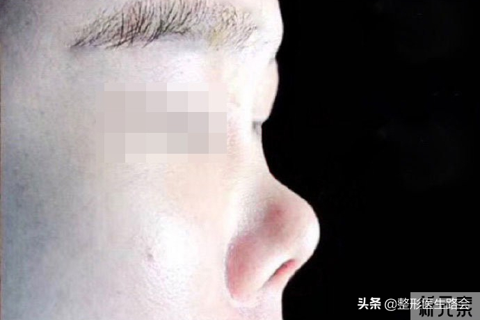 不想手术开刀,可以一直用玻尿酸注射隆鼻子吗? 图片-3