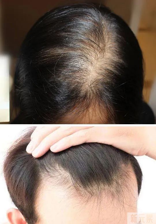 女性为什么也会得雄激素性脱发? 图片-2