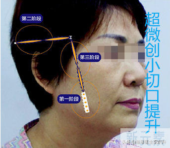 用埋线的方法,提升面部有多大真实效果? 图片-2