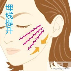 用埋线的方法,提升面部有多大真实效果? 图片-1