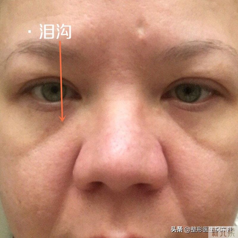怎么消除“三八纹”,也就是泪沟、法令纹、 图片-1