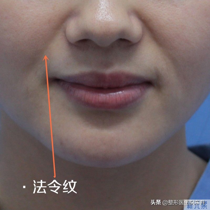 怎么消除“三八纹”,也就是泪沟、法令纹、 图片-2