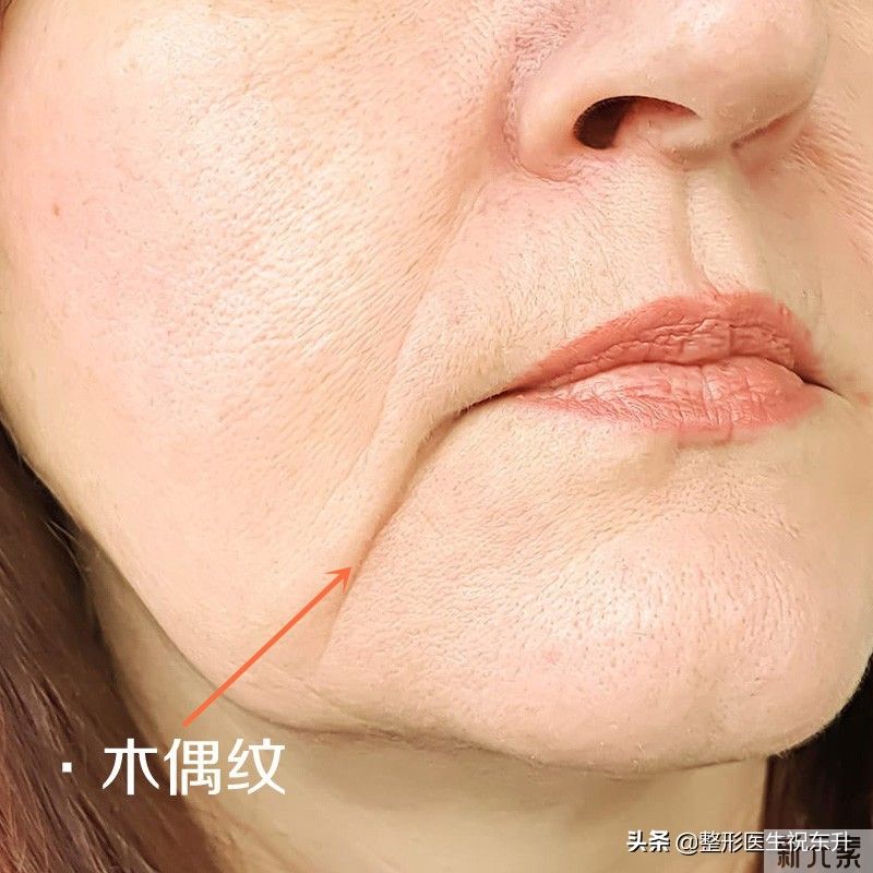 怎么消除“三八纹”,也就是泪沟、法令纹、 图片-3