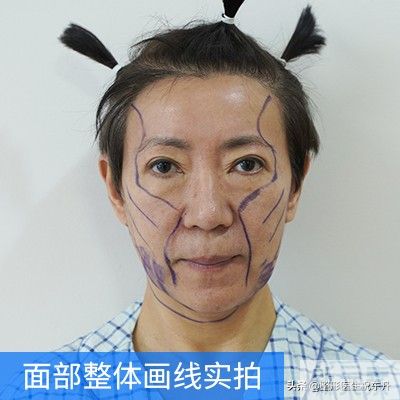 小拉皮手术后第40天,我的反馈来了! 图片-5
