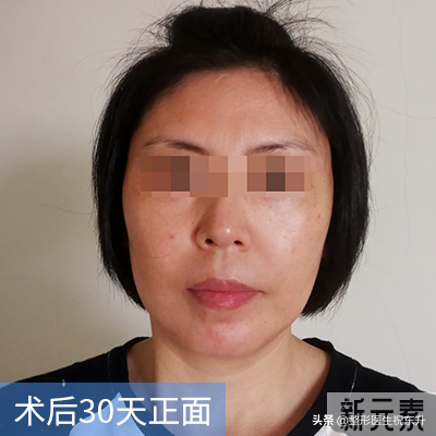 40、50岁的人还适合做小拉皮吗? 45 图片-8