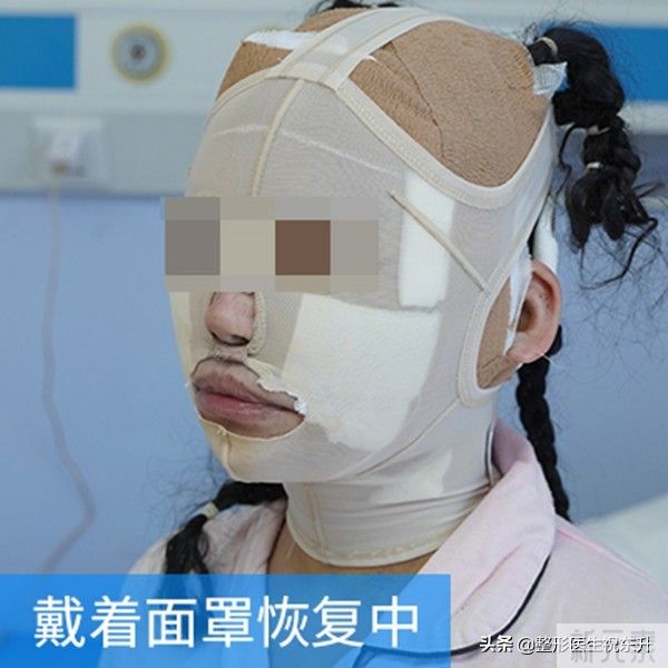 摊牌了!拉皮手术去法令纹,真的有用 图片-2
