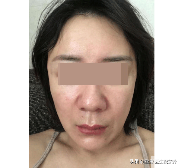 摊牌了!拉皮手术去法令纹,真的有用 图片-1