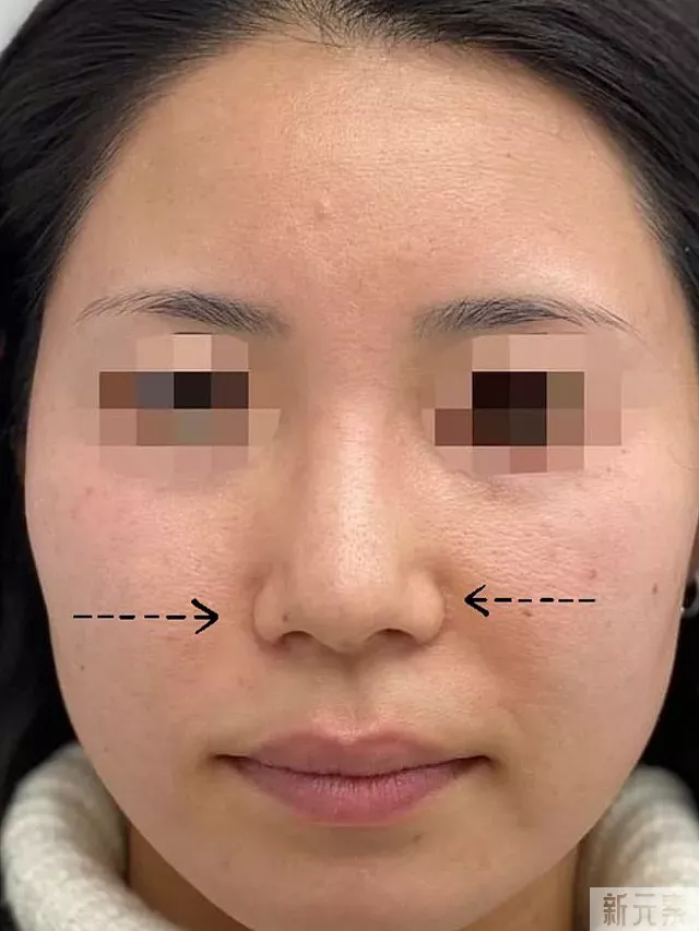 鼻子看起来特别“大”,一定要切鼻翼嘛? 图片-2