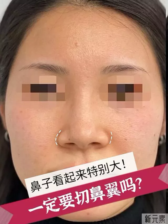 鼻子看起来特别“大”,一定要切鼻翼嘛? 图片-1