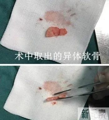 看看,做鼻修复时都从鼻子里取出了什么? 图片-10