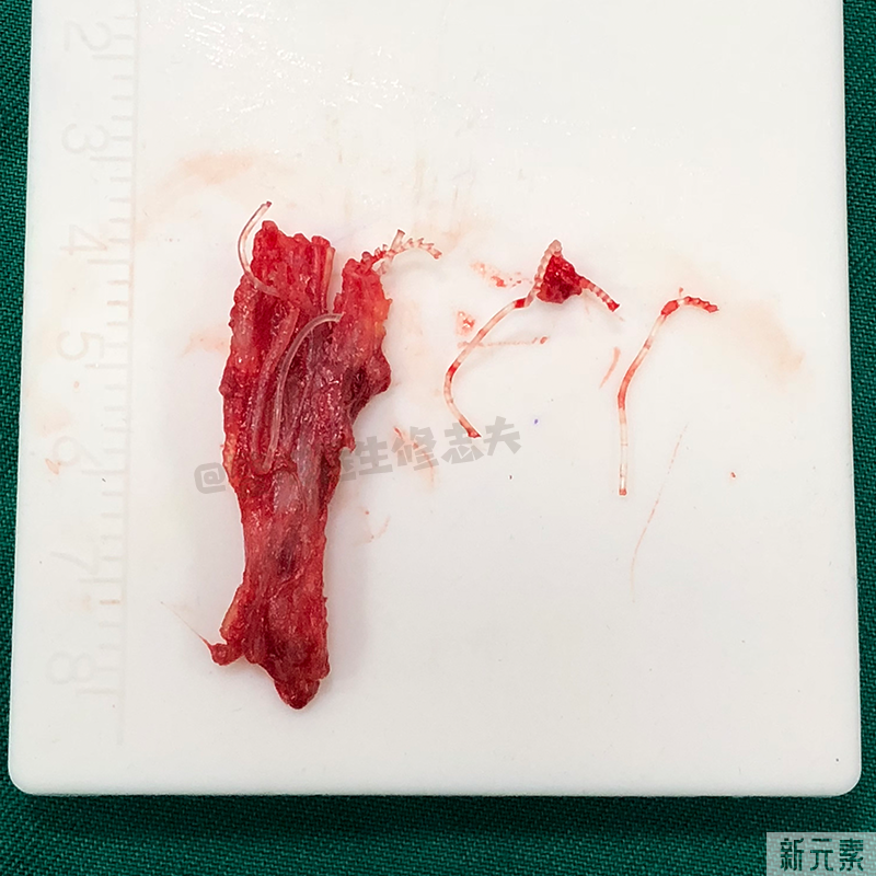 看看,做鼻修复时都从鼻子里取出了什么? 图片-14