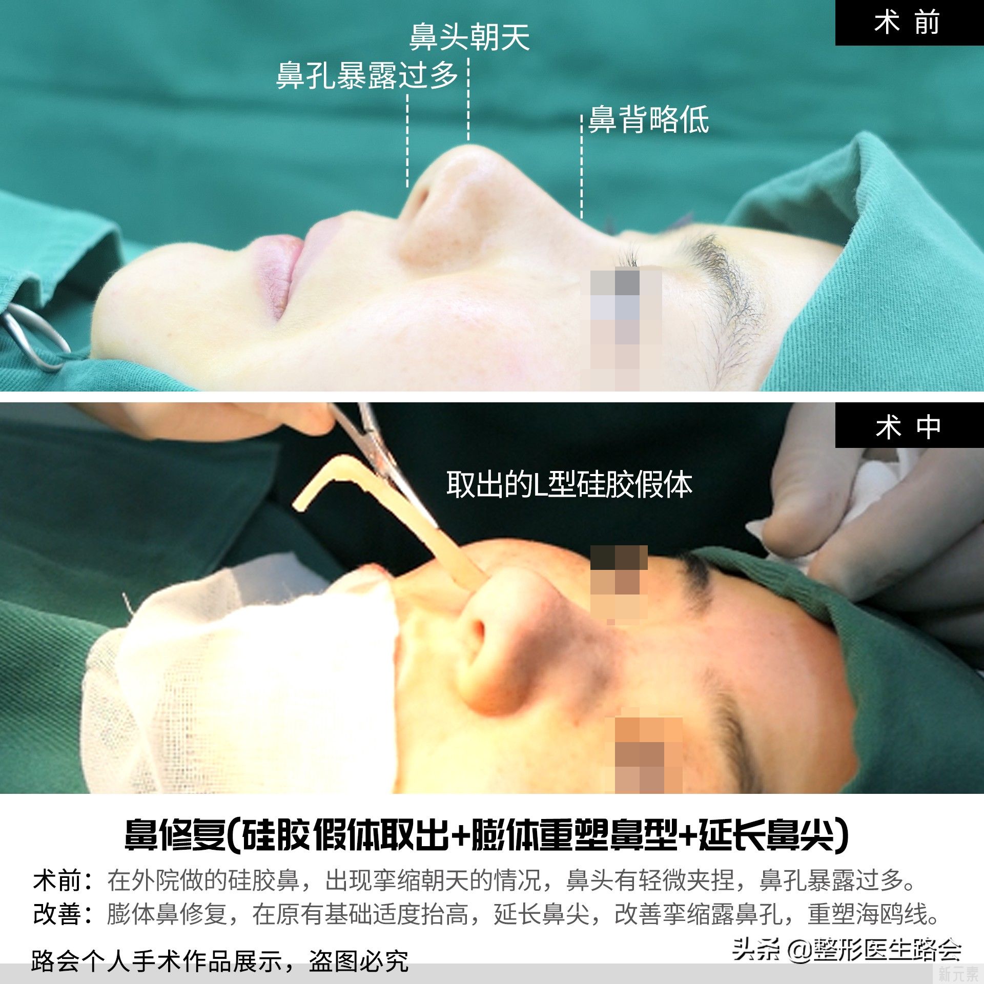 别拿“假体鼻修复”不当回事,听听医生怎么 图片-1