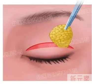 一次双眼皮手术可以同时解决哪些问题? 图片-2