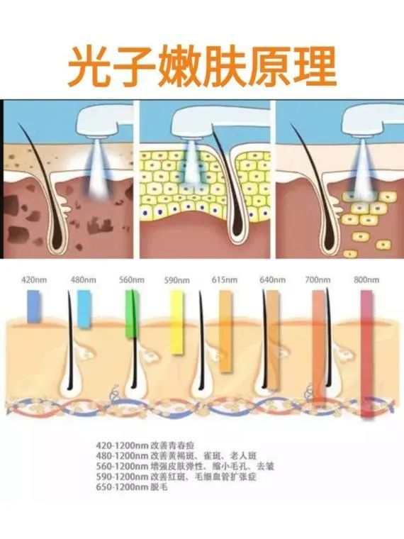 光子嫩肤有哪些种类? 图片-3