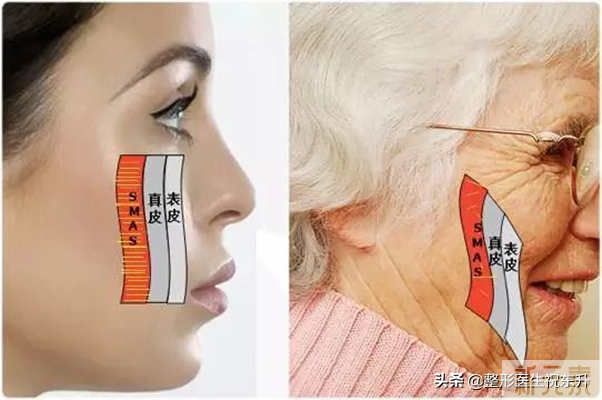 听说,40岁做拉皮手术,不如50、60岁做效果好? 图片-2