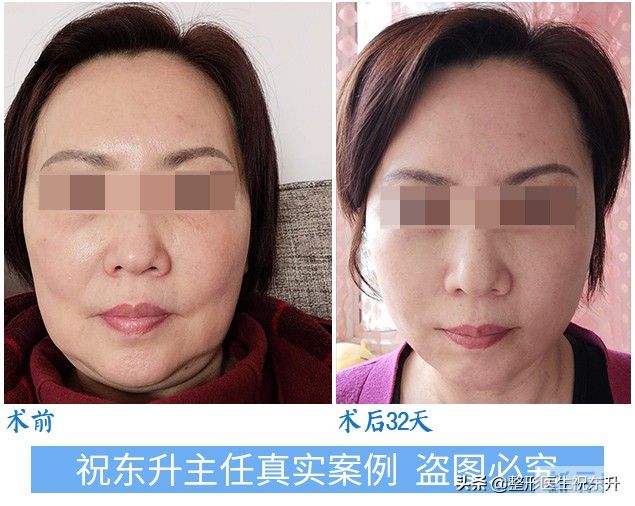 听说,40岁做拉皮手术,不如50、60岁做效果好? 图片-4