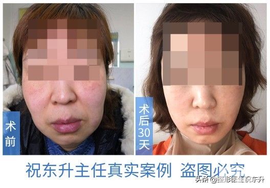 听说,40岁做拉皮手术,不如50、60岁做效果好? 图片-3