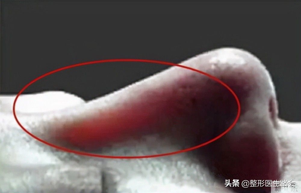 硅胶隆鼻│那些整形医生不会告诉你的,隆鼻手术的“副作用” 图片-3